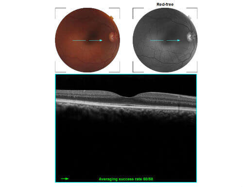 Optical Coherence Tomography (OCT)