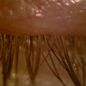 demodex blepharitis eyelashes