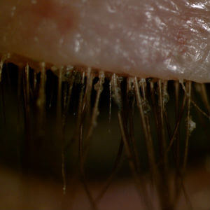 demodex blepharitis eyelash collarettes