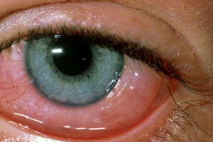 Allergic Conjunctivitis